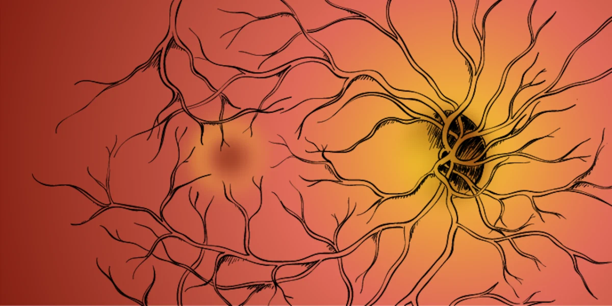 Phase III Trial Results Show Promise For New Macular Degeneration Drug   A9gvwzbd1b28jhpsyrcm.webp