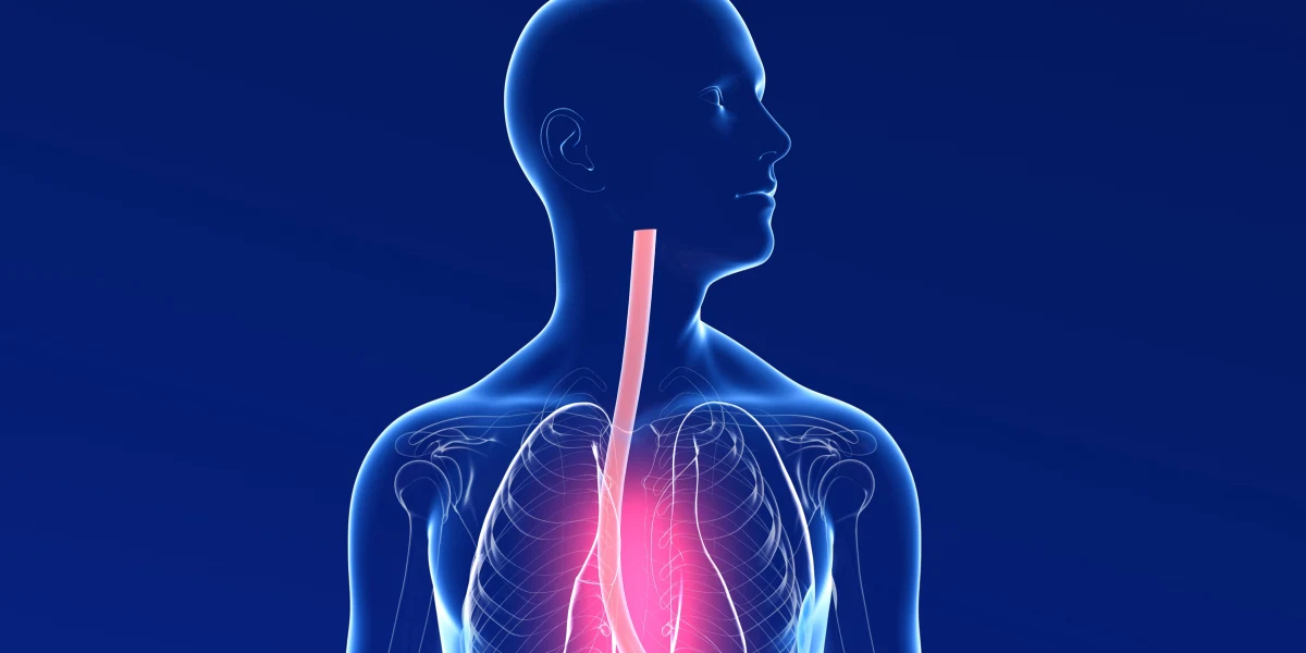 Is Eosinophilic Esophagitis Disappearing?