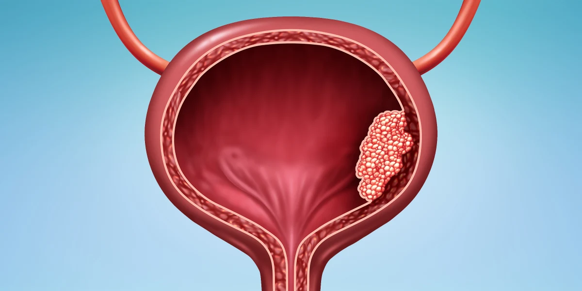 Urothelial Carcinoma Drug Shortages Insights from ASCO GU