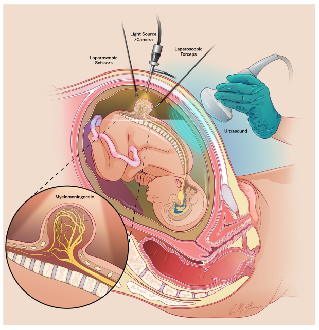 Riley Children’s performs first successful in-utero repair of spina bifida in Indiana